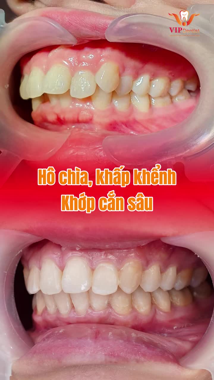 NỤ CƯỜI TRONG MƠ - NHỜ NIỀNG RĂNG CÙNG VIP DENTIST!