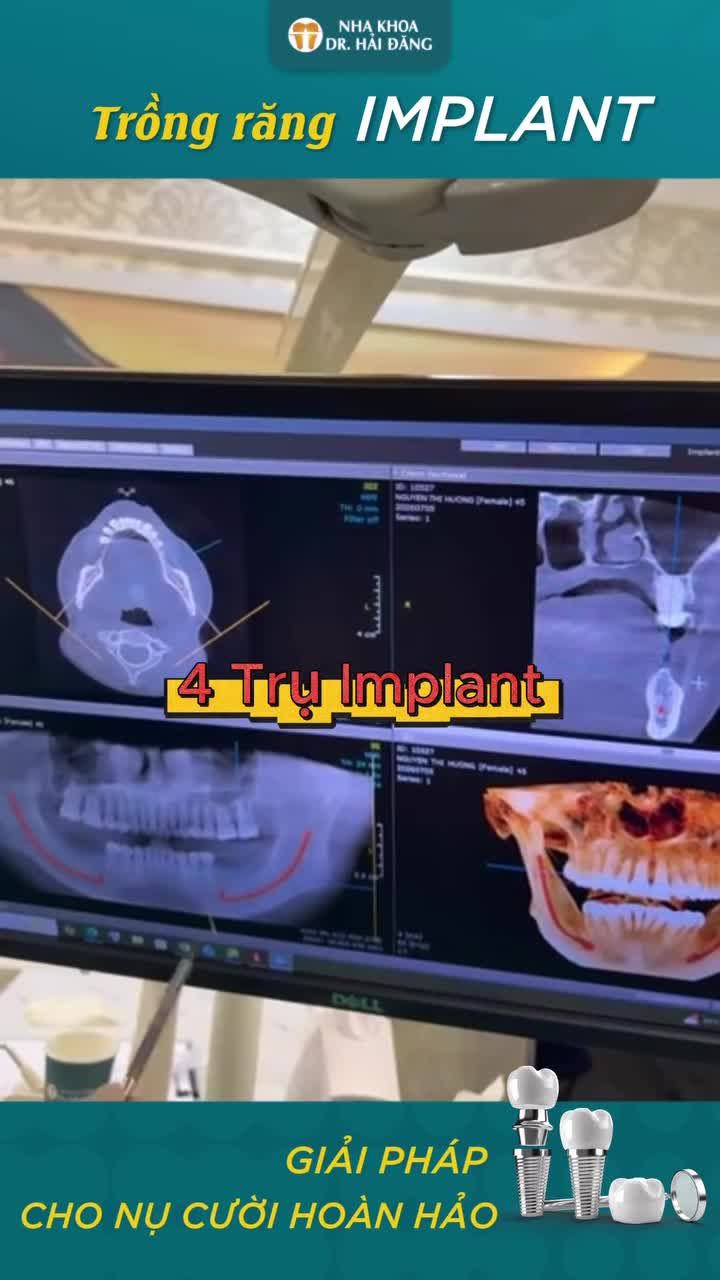 4 TRỤ IMPLANT - ĐẦU TƯ MỘT LẦN - BỀN LÂU NHIỀU NĂM CHO KHÁCH VIỆT KIỀU