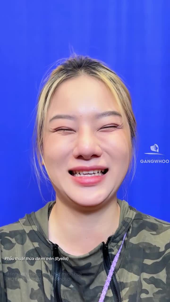 Màn lột xác đầy bất ngờ sau 2 tháng cắt mí tại Gangwhoo