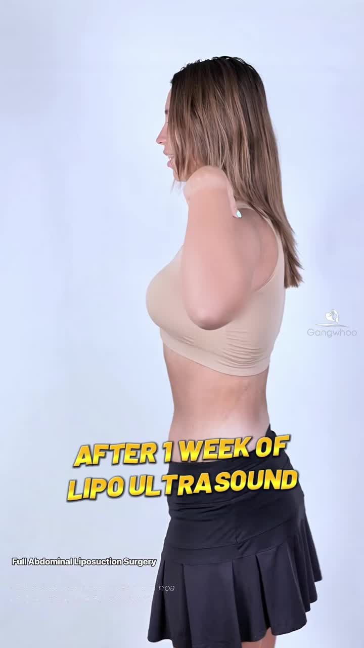 khách Nga sau 1 tuần giảm mỡ Lipo Ultrasound)