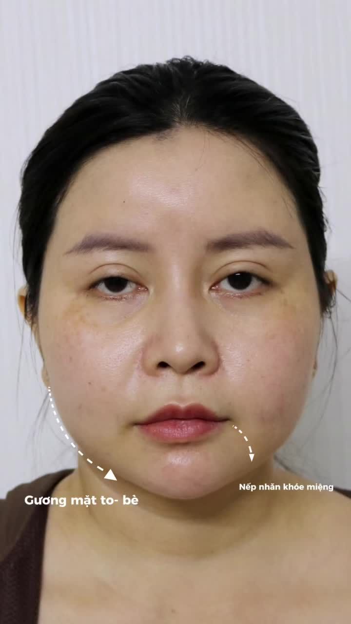 GƯƠNG MẶT TO BÈ, RÃNH CƯỜI SÂU KHIẾN BẠN GIÀ HƠN TUỔI?