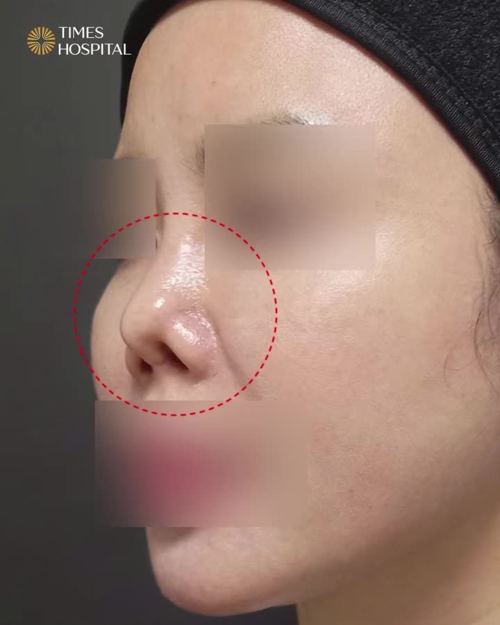 MŨI VIÊM, CO RÚT SAU NHIỀU LẦN CHỈNH SỬA – XỬ LÝ THẾ NÀO?