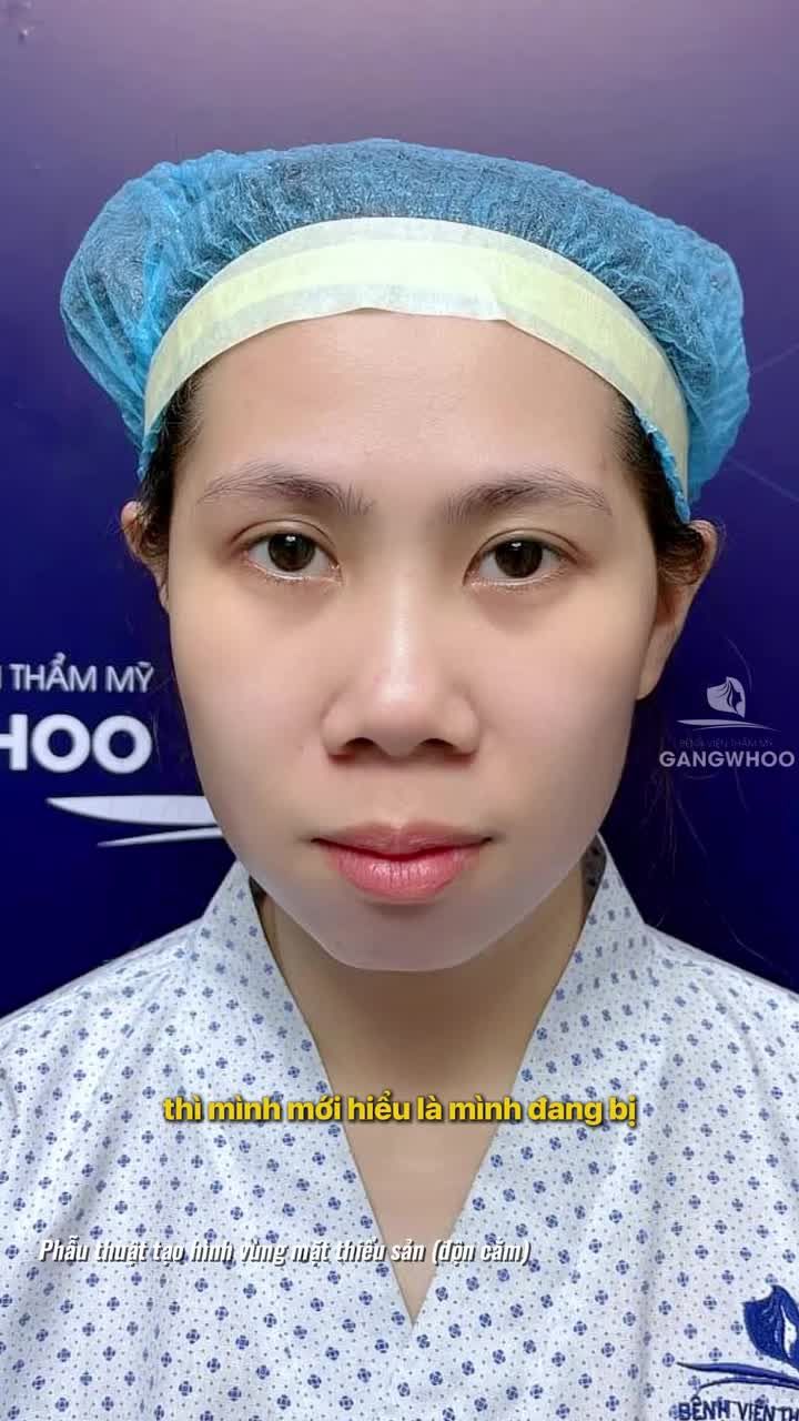Xóa bỏ cằm hô, lẹm chỉ sau 30 phút độn cằm