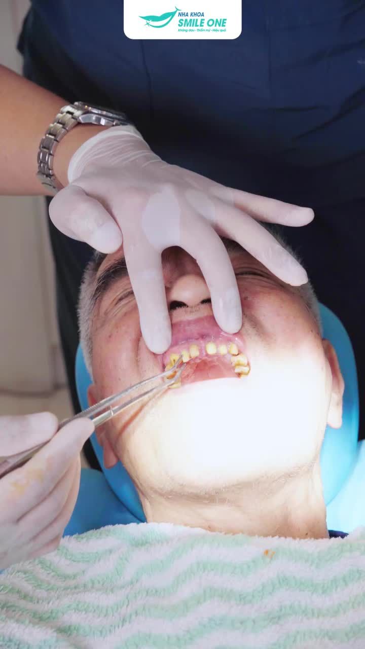U70 BỊ LUNG LAY RĂNG CỬA IẢI PHÁP CẦU RĂNG SỨ BẢO TỒN RĂNG THẬT CÙNG BS NGUYỄN TUẤN DƯƠNG