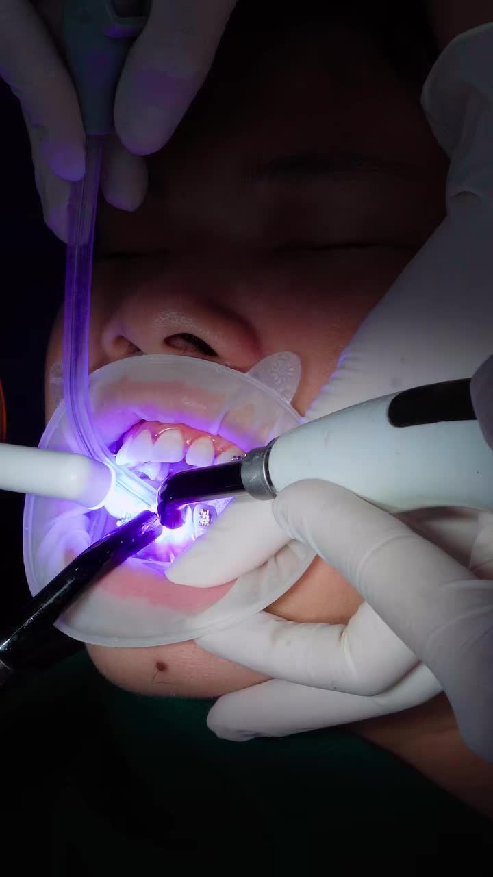 CẢI THIỆN HÀM RĂNG THƯA VỚI NIỀNG RĂNG NẮN CHỈNH