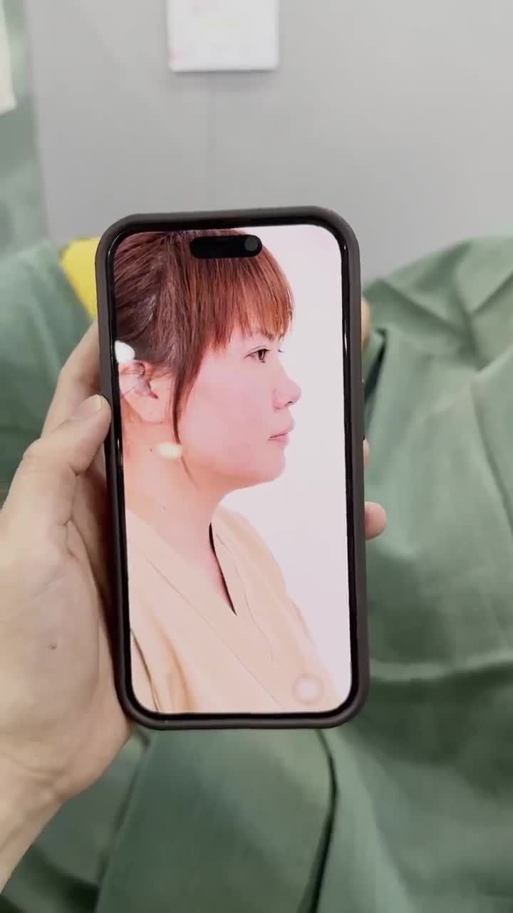 TRẢ KẾT QUẢ SAU 60 PHÚT THỰC HIỆN NÂNG MŨI CẤU TRÚC DR. HOẠT KH. CAO THẢO (VIỆT KIỀU MỸ)