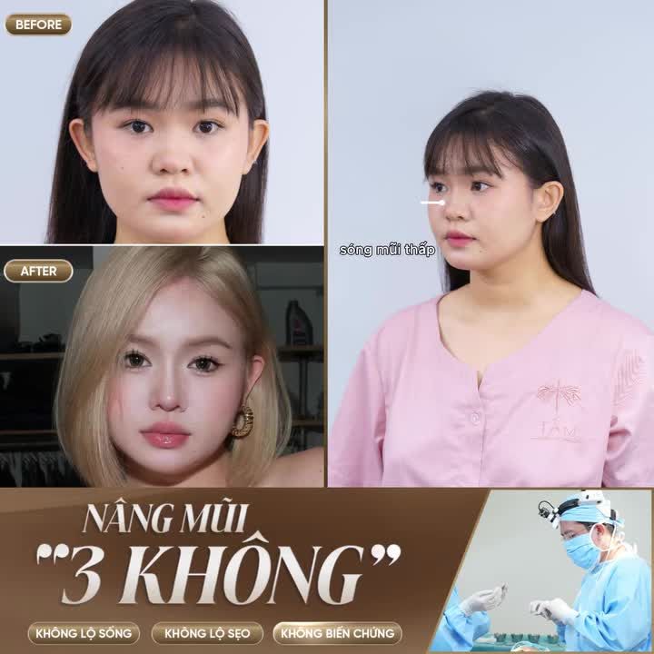 Một ca nâng mũi với tiêu chuẩn "3 không": không đau, không sẹo, không lộ sóng sẽ như thế nào?