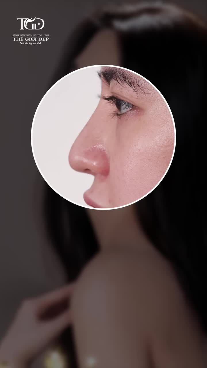 Hành trình thay đổi của quý Cô sau lần thứ 2 tái phẫu thuật mũi cấu trúc