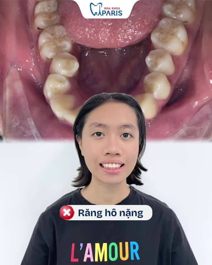 RĂNG HÔ NẶNG NIỀNG RĂNG TRONG SUỐT CÓ CẢI THIỆN ĐƯỢC KHÔNG?
