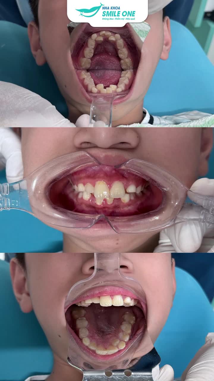 Bố mẹ luôn tự hỏi ""Bao giờ là thời điểm đẹp nhất để niềng răng cho con?