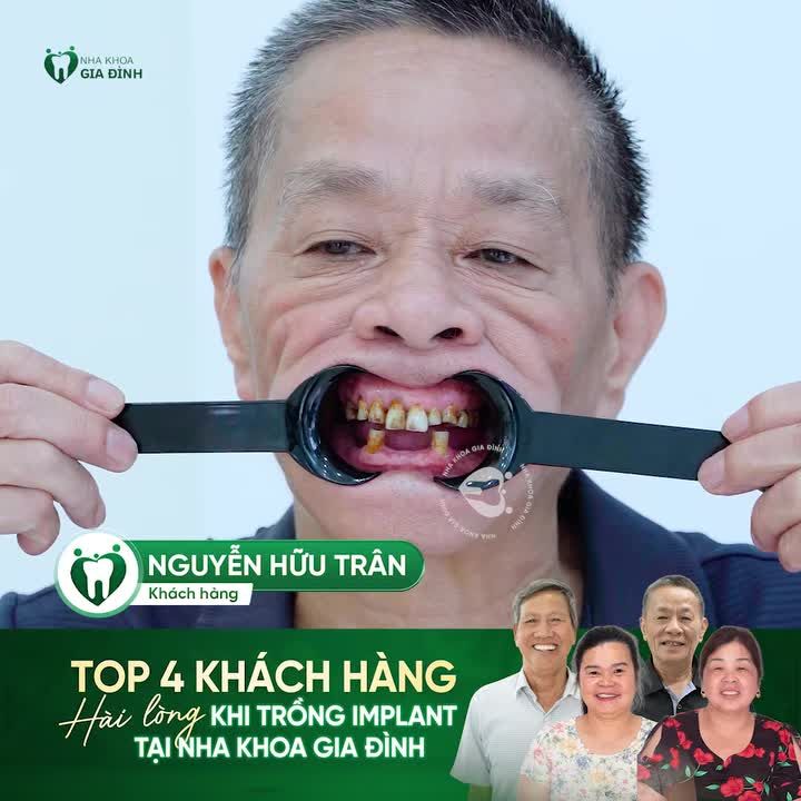 LẤY LẠI HÀM RĂNG CHẮC KHỎE SAU NHIỀU NĂM ĂN NHAI KHÓ KHĂN