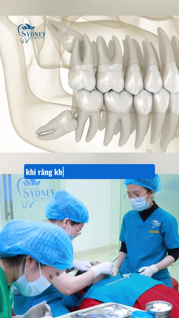 Răng khôn sưng đau có nên nhổ bỏ ngay?