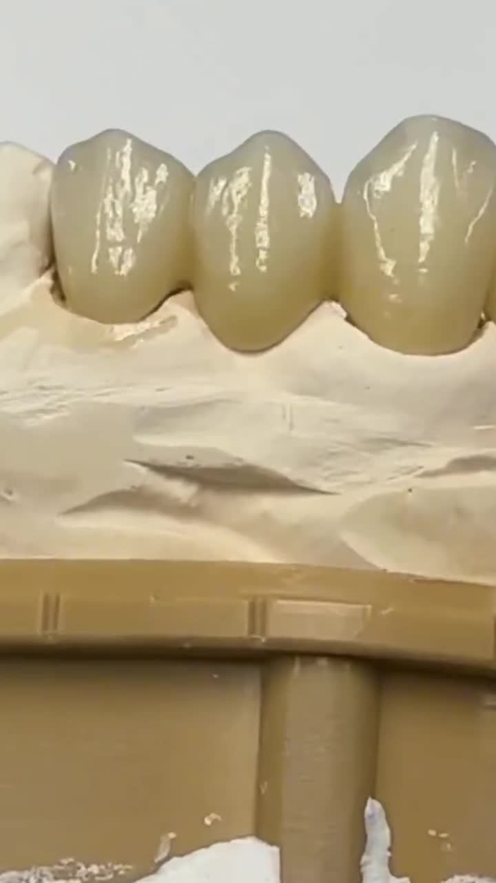Cầu răng sứ khôi phục ăn nhai