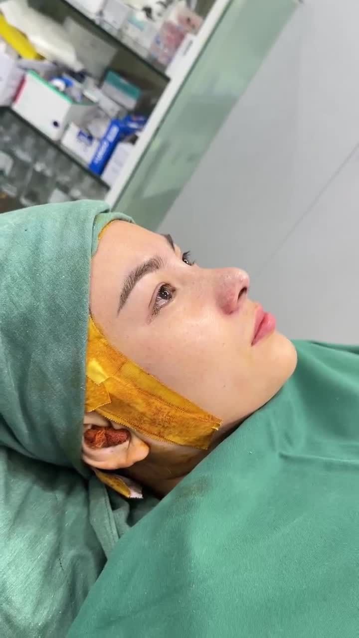 60 phút NÂNG MŨI CẤU TRÚC DR. HOẠT