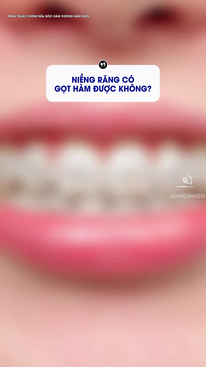 Đang niềng răng thì có được gọt góc hàm hay không?