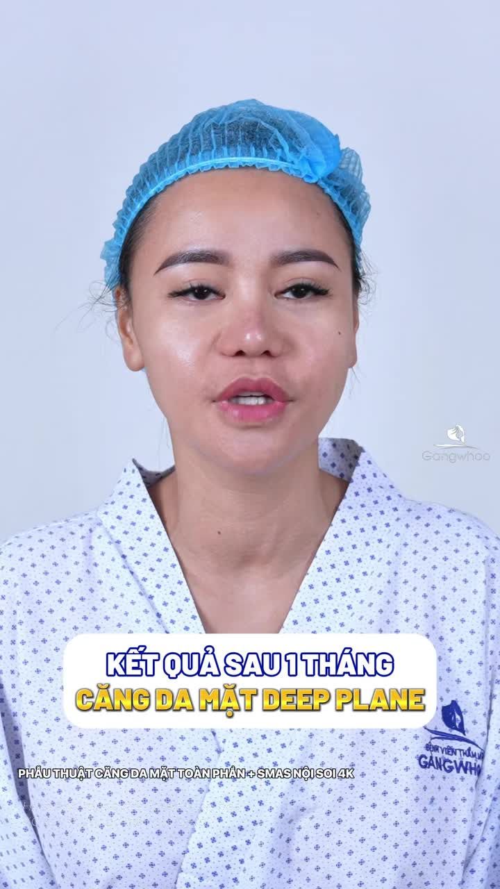 Kết quả sau 1 tháng thực hiện căng da mặt Deep Plane bạn bè ai cũng khen không sẹo trẻ ra