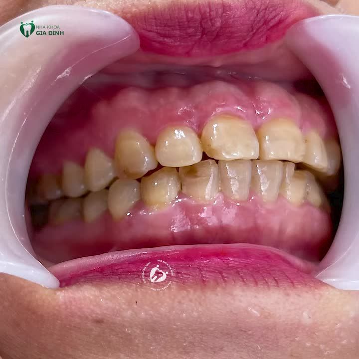BS NGUYỄN VIỆT TUYẾN PHÂN TÍCH TÌNH TRẠNG RĂNG KHÁCH HÀNG HẠNH