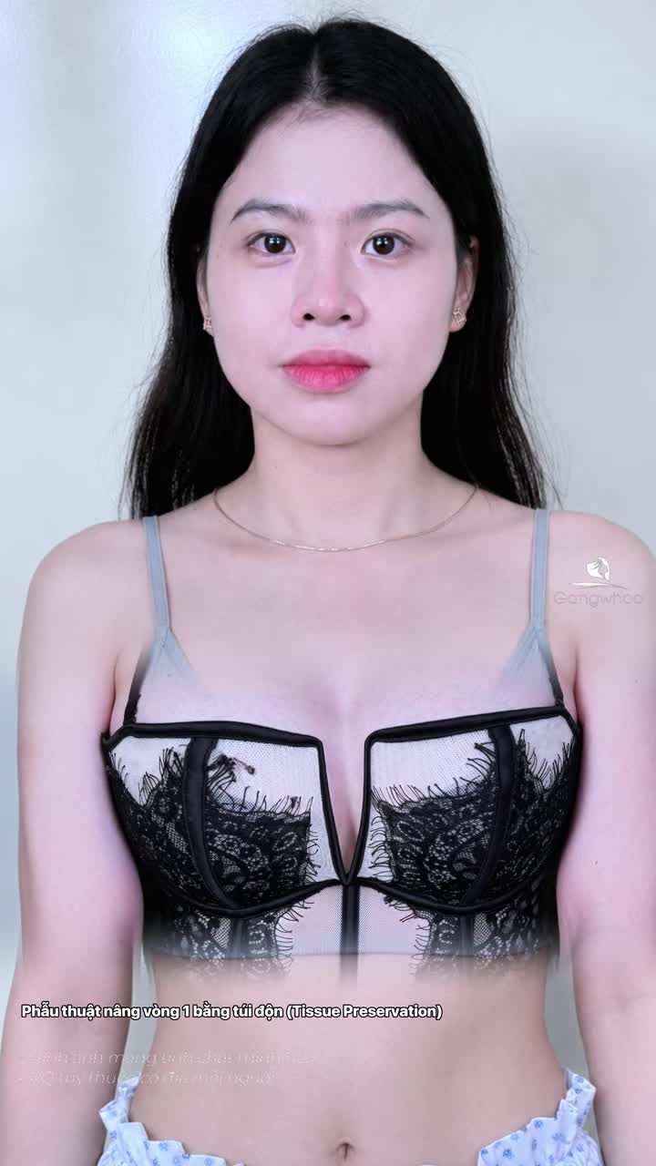 Mẹ bỉm thay đổi diện mạo mới tự tin hơn sau combo trùng tu vòng 1 + nâng mũi tại Gangwhoo