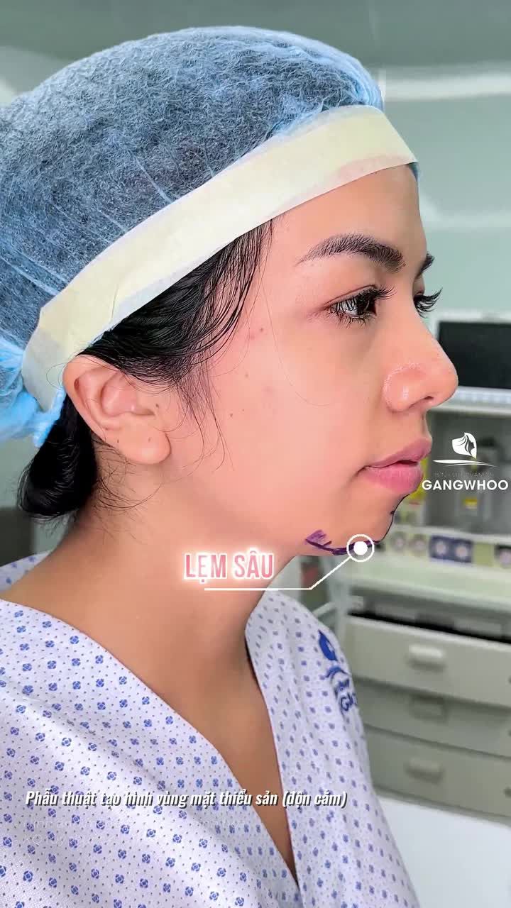 Đừng để chiếc cằm ngắn, lẹm "dìm" nhán sắc của bạn. Độn cằm ngay!