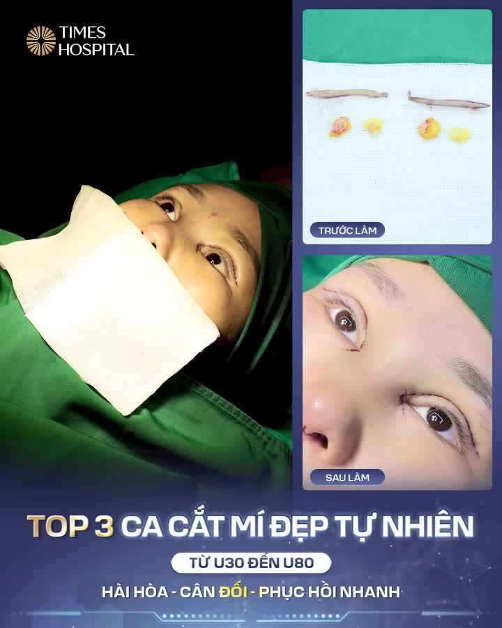 3 CA CẮT MÍ - 3 VẺ ĐẸP RIÊNG