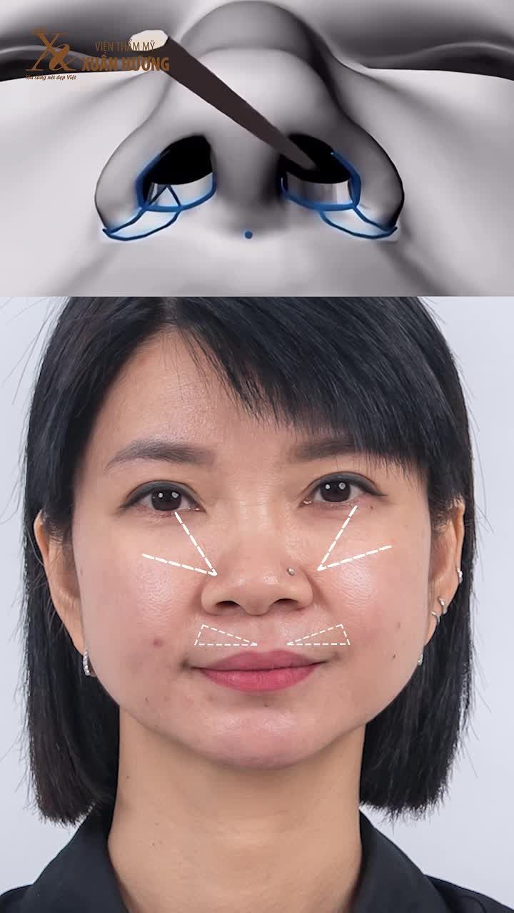 SIÊU MẪU HẠ VY LỘT XÁC VỚI COMBO CẮT MÍ - NÂNG MŨI