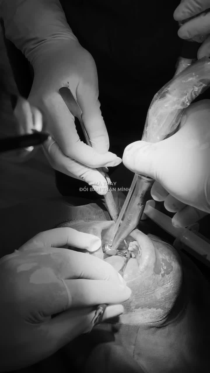 IMPLANT NÂNG XƯƠNG CÙNG ThS.BS. TRẦN VĂN VUI