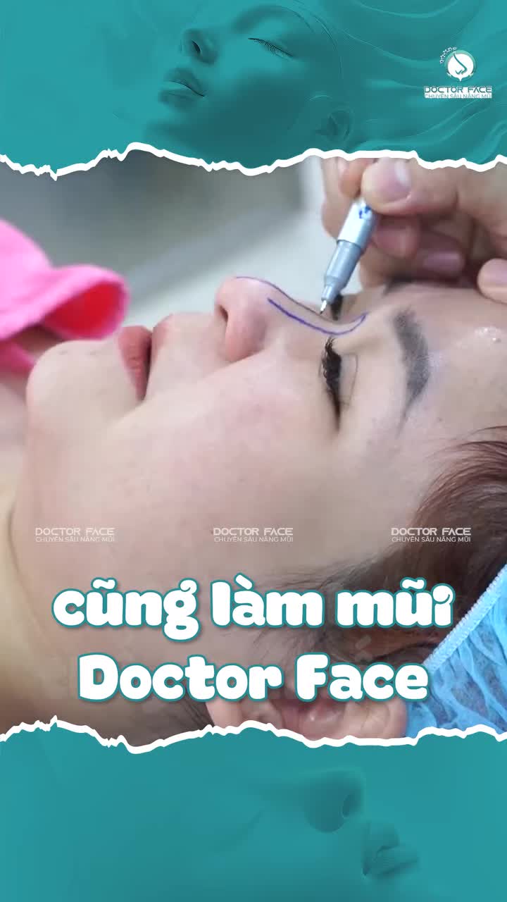 Đầu mũi cụp, sống mũi thấp, với lựa chọn nâng mũi sụn sườn toàn phần thì bác sĩ sẽ điều chỉnh như thế nào?