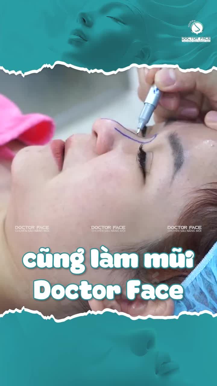 Đầu mũi cụp, sống mũi thấp, với lựa chọn nâng mũi sụn sườn toàn phần thì bác sĩ sẽ điều chỉnh như thế nào?