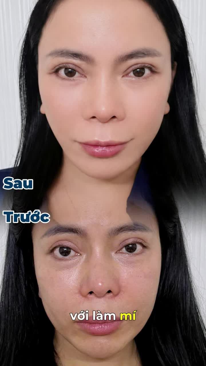 THAY ĐỔI DIỆN MẠO MỚI NHỜ CĂNG DA V-LINE TẠI DR. TRÍ