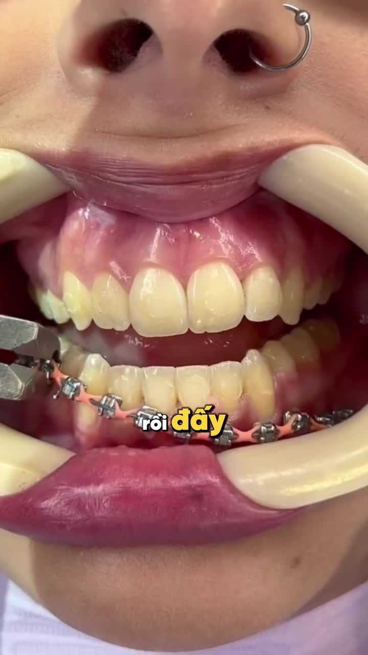 DẤU HIỆU BẠN SẮP ĐƯỢC THÁO NIỀNG