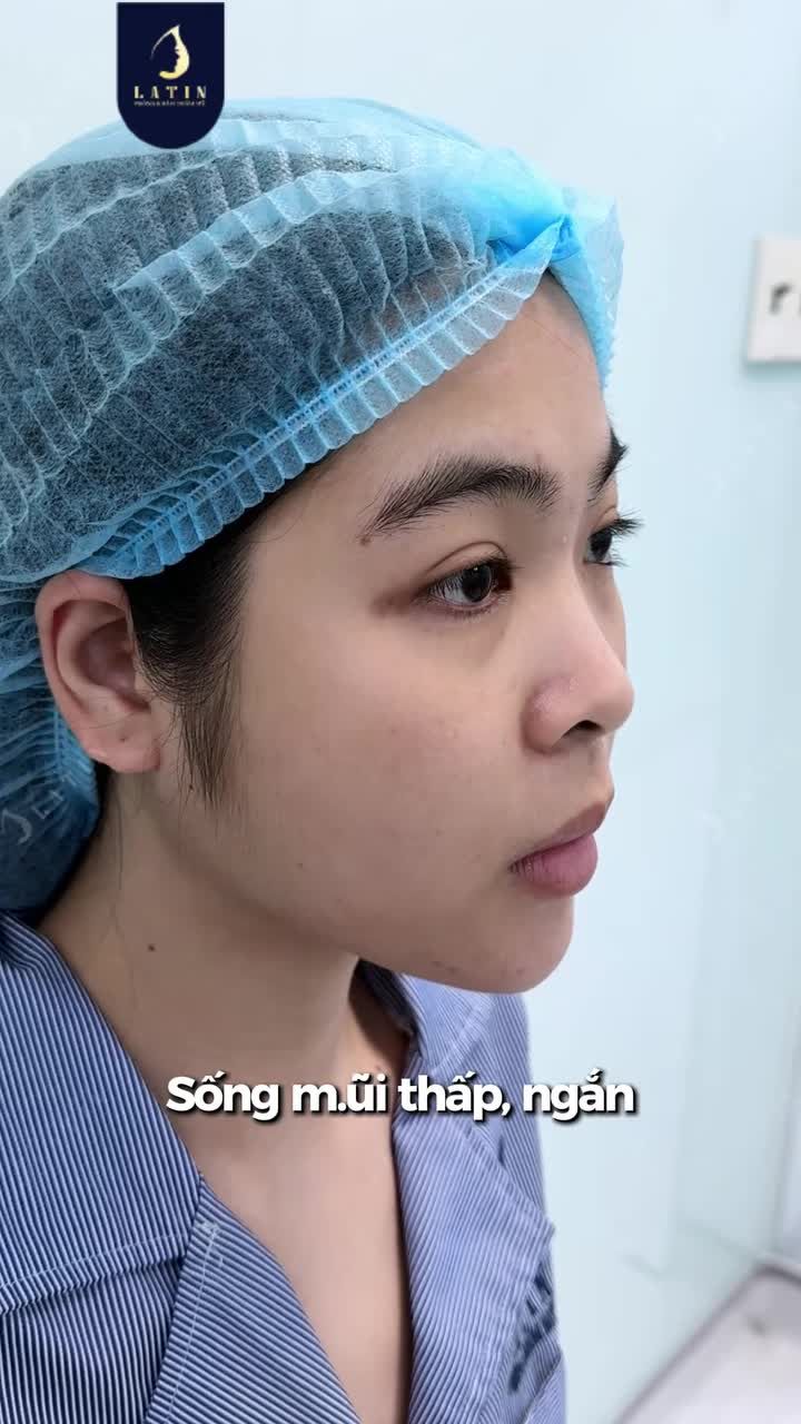 FLEX NHẸ DÁNG MŨI “XINH IU” SAU NÂNG CẤU TRÚC SURGIFORM