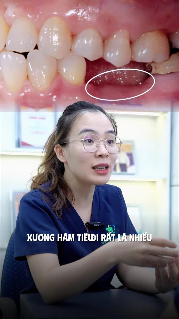 MÁNG HƯỚNG DẪN PHẤT THUẬT IMPLANT ĐƯỢC TẠO RA NHƯ THẾ NÀO?