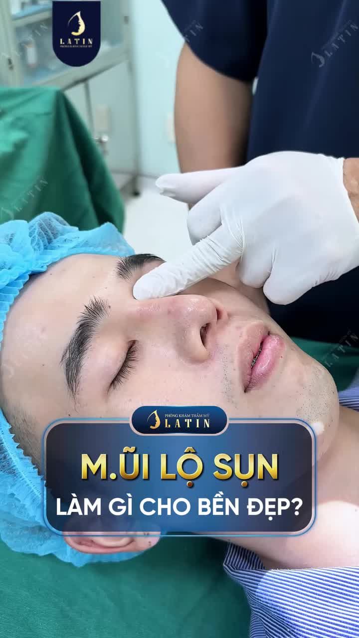 MŨI LỘ SỤN LÀM GÌ CHO BỀN ĐẸP?