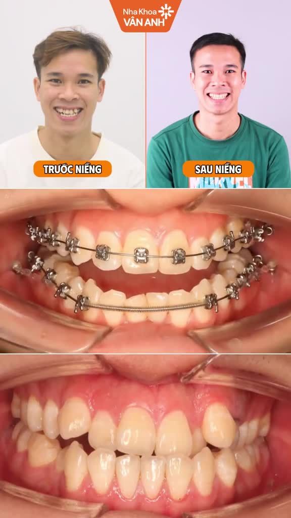 Nụ cười rạng rỡ trẻ hơn 10 tuổi liệu các bạn có dám??