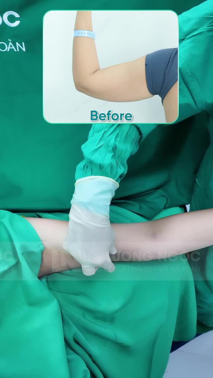 Siêu phẩm bắp tay thon gọn từ Ekip Bác sĩ Lương Ngọc
