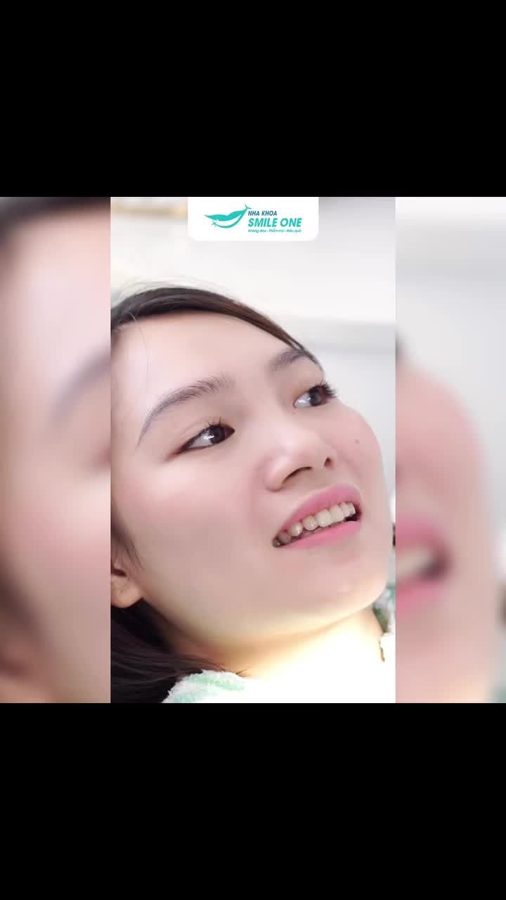 1 CHIẾC RĂNG CỬA XOAY LỆCH CÓ CẦN NIỀNG CẢ HÀM KHÔNG?