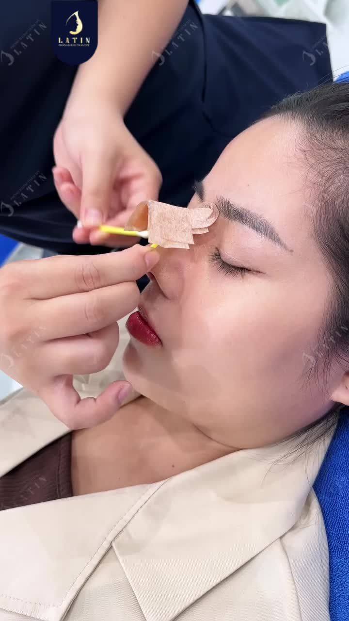 “KHUI FORM” MŨI CẤU TRÚC SAU 10 NGÀY