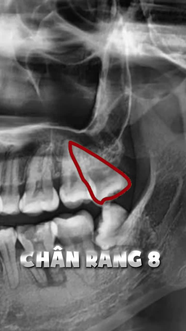 Nhổ răng 7 hay răng 8 để niềng răng — nghe tưởng đơn giản nhưng lại là quyết định ảnh hưởng trực tiếp đến kết quả chỉnh nha của bạn.