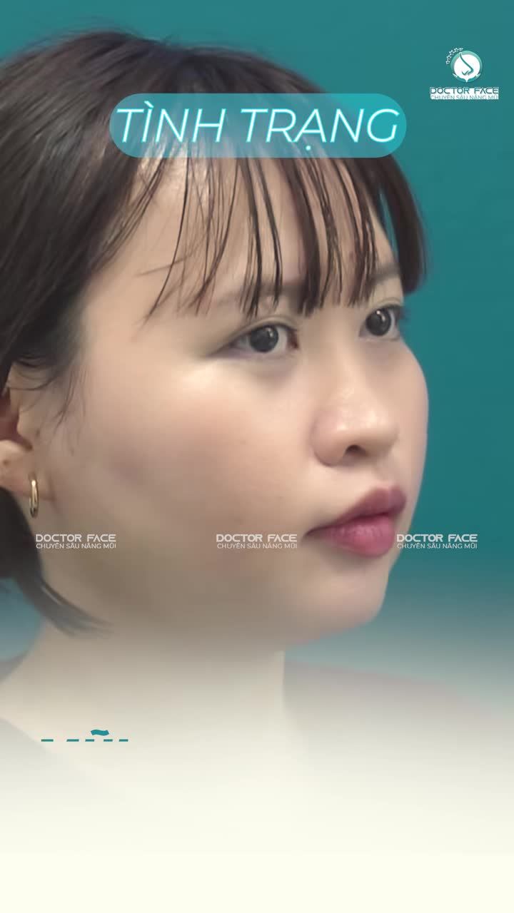Nghe tư vấn nâng mũi rất nhiều, nhưng bạn đã thật sự hình dung được dáng mũi sau nâng trên gương mặt mình chưa?
