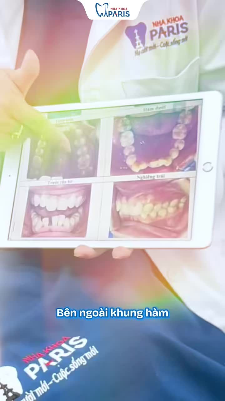 RĂNG KHỚP CẮN SÂU, LỆCH LẠC NẶNG CÓ THỂ CẢI THIỆN BẰNG NIỀNG KHAY TRONG KHÔNG?