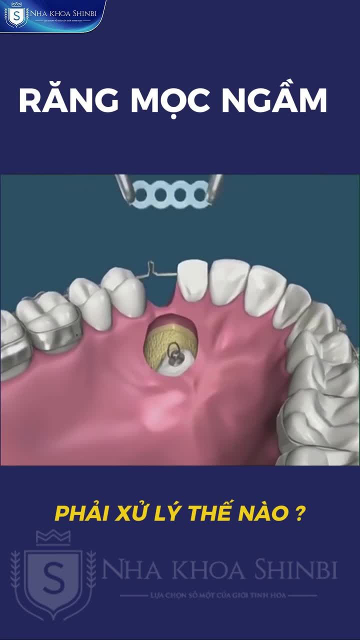 Răng mọc ngầm phải xử lý như thế nào?