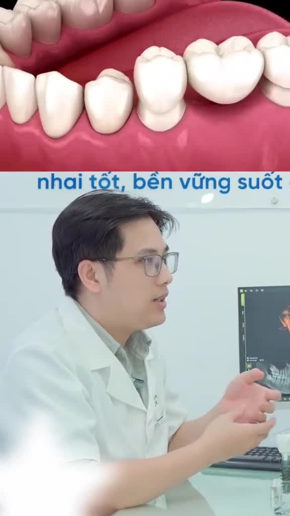 MẤT 1 RĂNG NÊN LÀM CẦU RĂNG SỨ HAY TRỒNG IMPLANT?