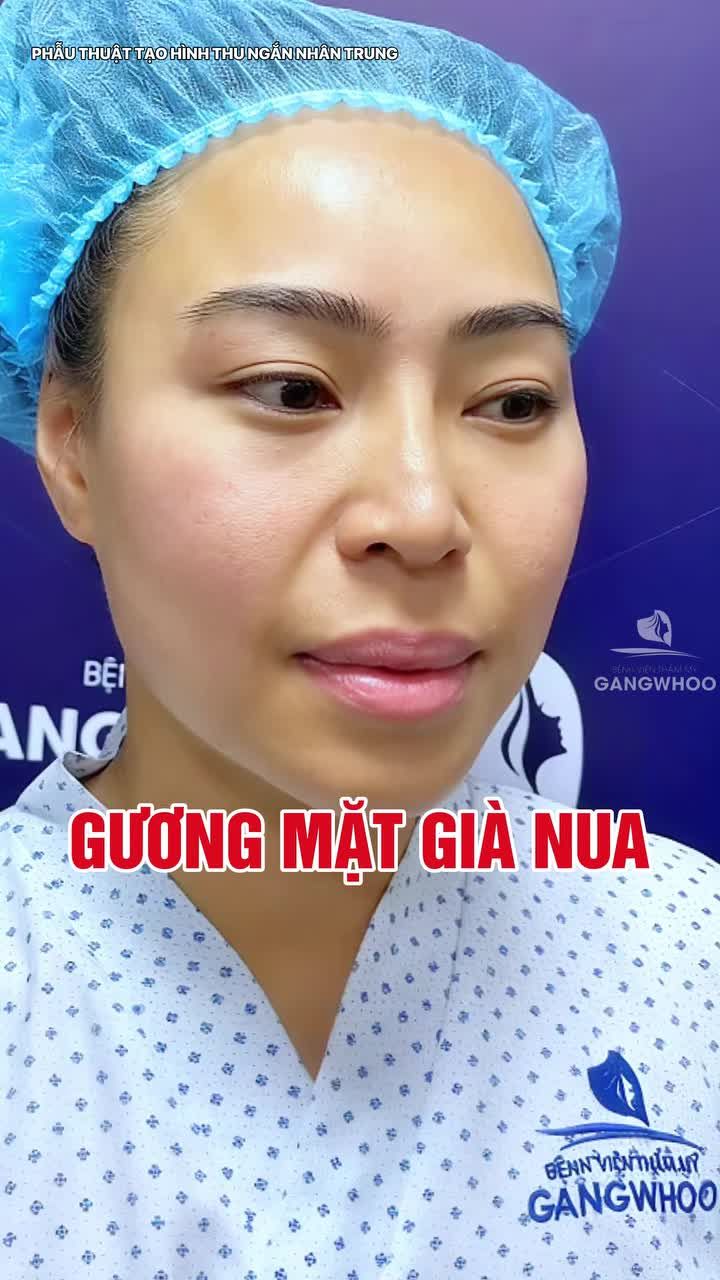 Nhân trung dài - Nguyên nhân khiến gương mặt trông già nua
