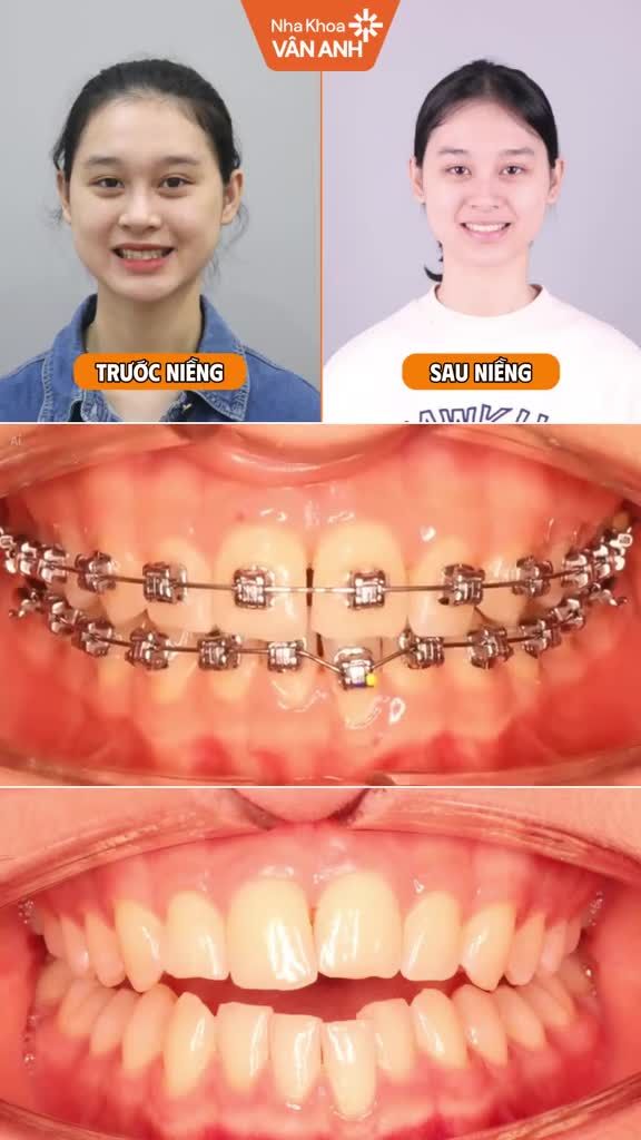 Cải thiện nụ cười đều hơn, đẹp hơn, đúng tỉ lệ hơn với NKVA