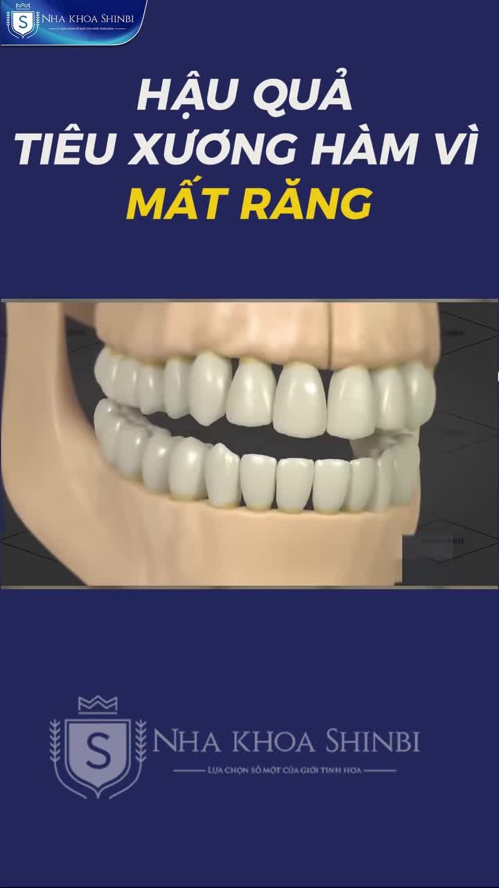 HẬU QUẢ TIÊU XƯƠNG HÀM VÌ MẤT RĂNG