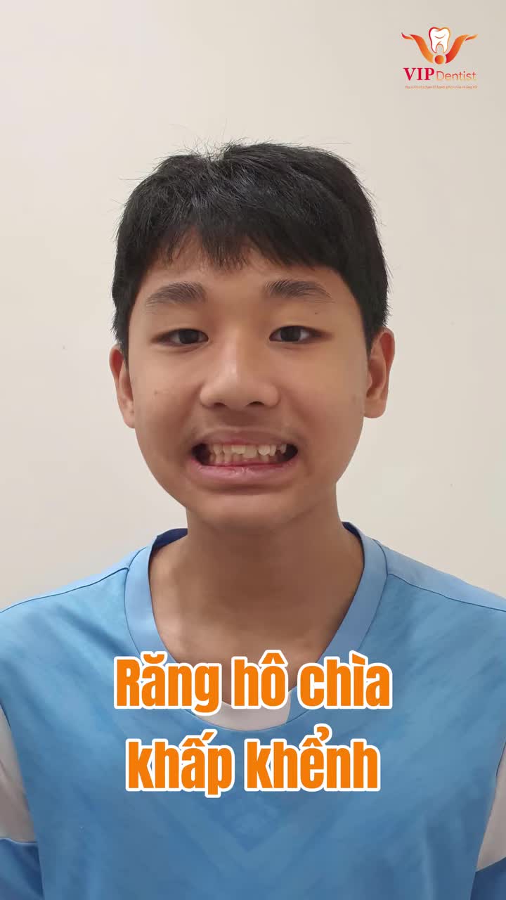 Từ 1 hàm răng "cái ra cái vào" cùng ngắm nhìn sự thay đổi đột phá của Nguyễn Hoàng Minh!
