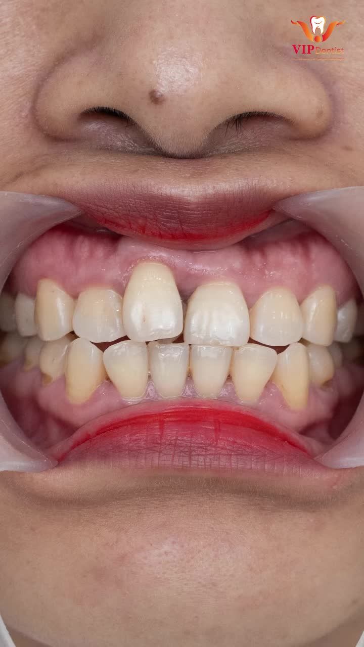 E ấp, ít cười vì hàm răng kém sắc, giờ đây chị Hoa Mai đã bung nở nụ cười rạng rỡ như những đóa hoa, với trọn bộ 16 răng sứ Ceramill.