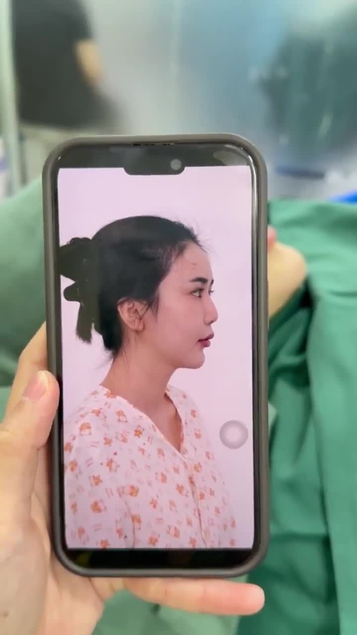 KẾT QUẢ SAU 60 PHÚT NÂNG MŨI CẤU TRÚC - SỬA LẠI MŨI HỎNG KH. TRANG ĐÀI