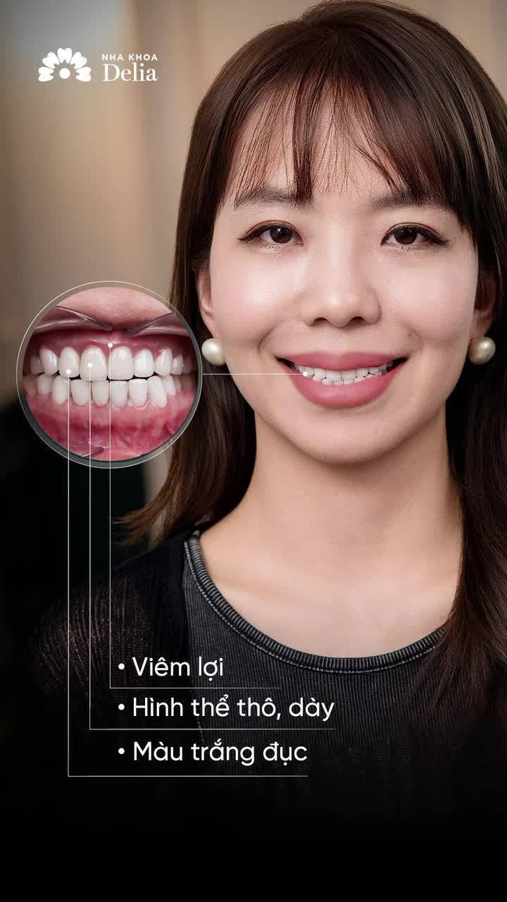 8 năm sống với bộ răng sứ thô dày và cái kết đẹp khi đặt trọn niềm tin vào Delia