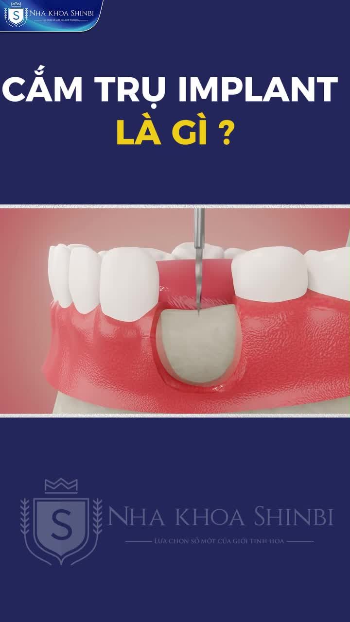 CẮM TRỤ IMPLANT LÀ GÌ ?